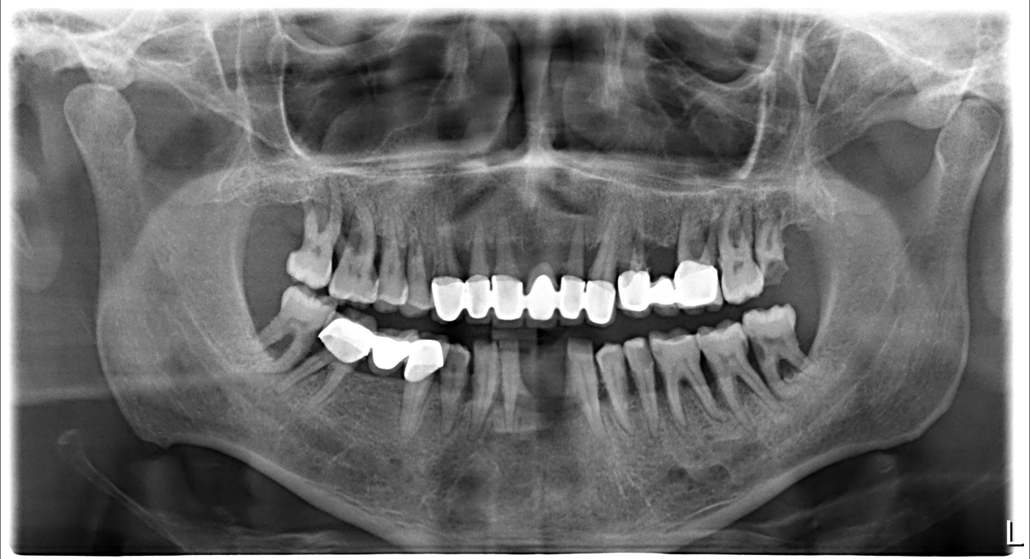 Naxis NX30 Full Mouth - Germany - Naxis