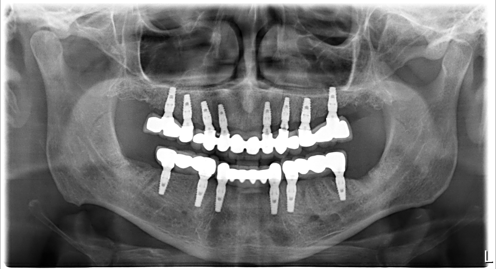 Naxis NX30 Full Mouth - Germany - Naxis