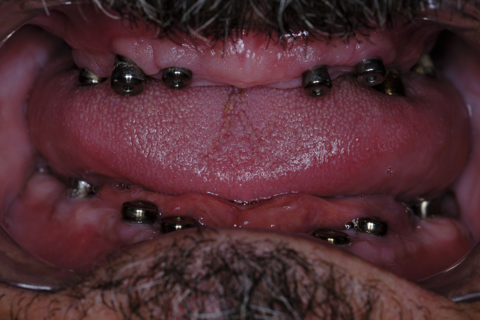 Naxis NX30 Full Mouth - Germany - Naxis