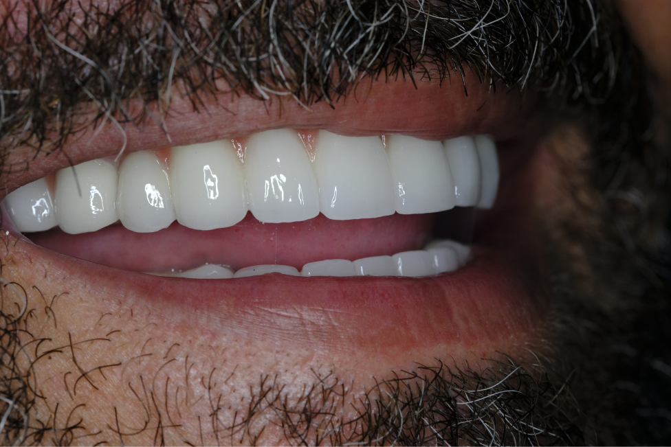 Naxis NX30 Full Mouth - Germany - Naxis