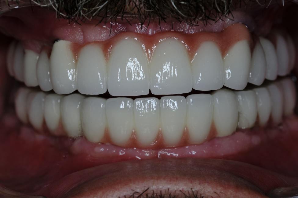 Naxis NX30 Full Mouth - Germany - Naxis