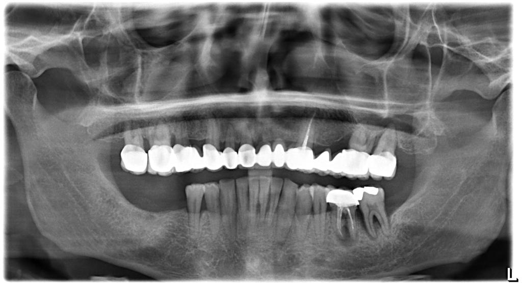 Implant Treatment with Naxis Implants in a Patient with Diabetes and Heavy Smoking-Alcohol Use: A Case Presentation - Romania - Naxis