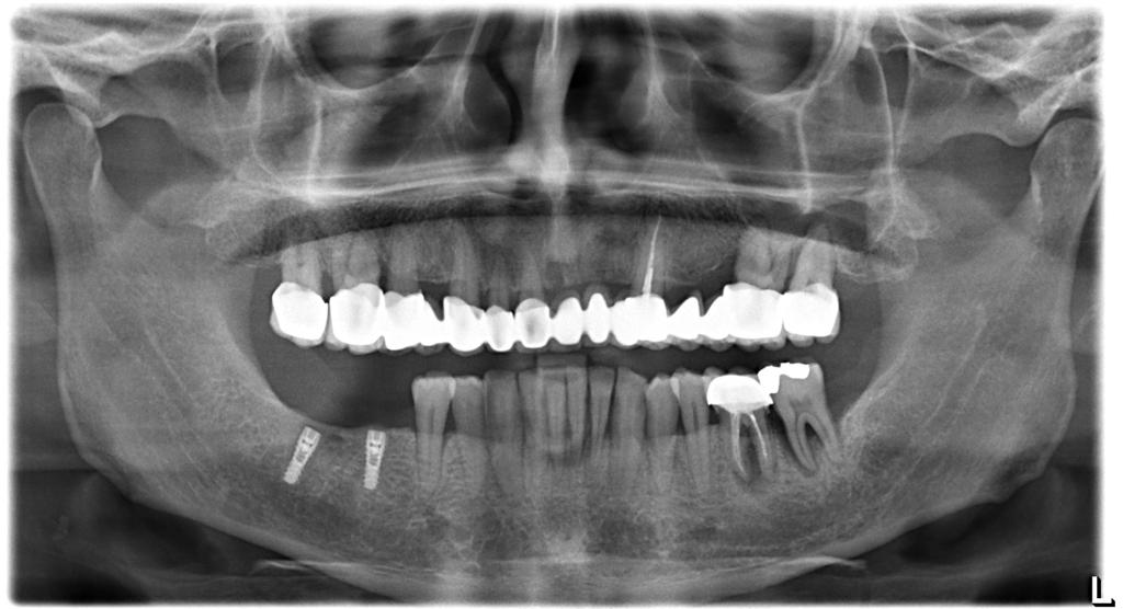 Implant Treatment with Naxis Implants in a Patient with Diabetes and Heavy Smoking-Alcohol Use: A Case Presentation - Romania - Naxis