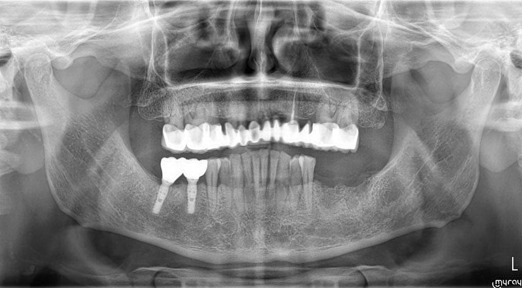 Implant Treatment with Naxis Implants in a Patient with Diabetes and Heavy Smoking-Alcohol Use: A Case Presentation - Romania - Naxis