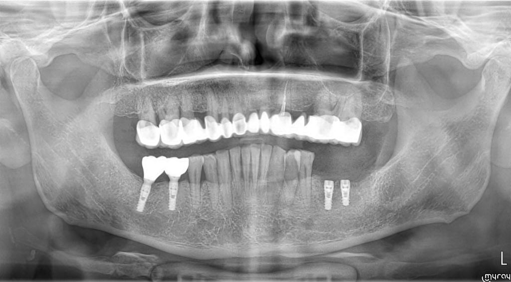 Implant Treatment with Naxis Implants in a Patient with Diabetes and Heavy Smoking-Alcohol Use: A Case Presentation - Romania - Naxis