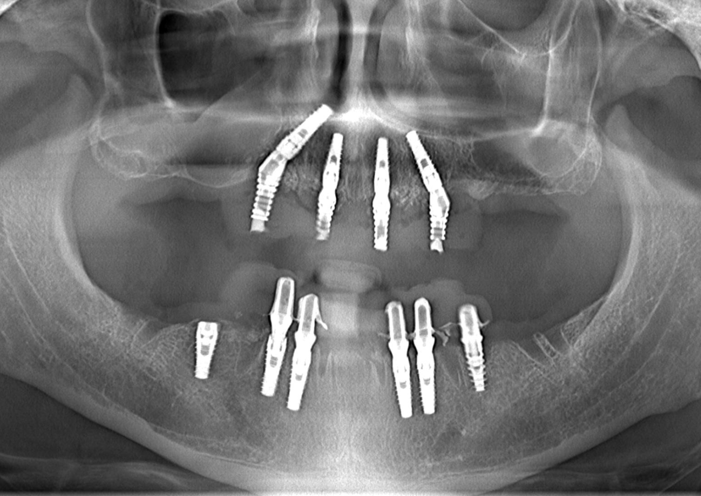 Sinus Avoidance Technique: Placement of 4 Upper Jaw and 6 Lower Jaw Implants - Turkiye - Naxis