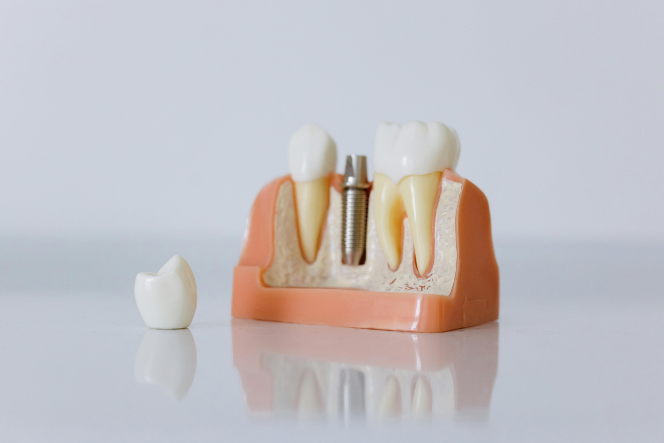 Frequently Asked Questions About Dental Implants - Blog - Naxis