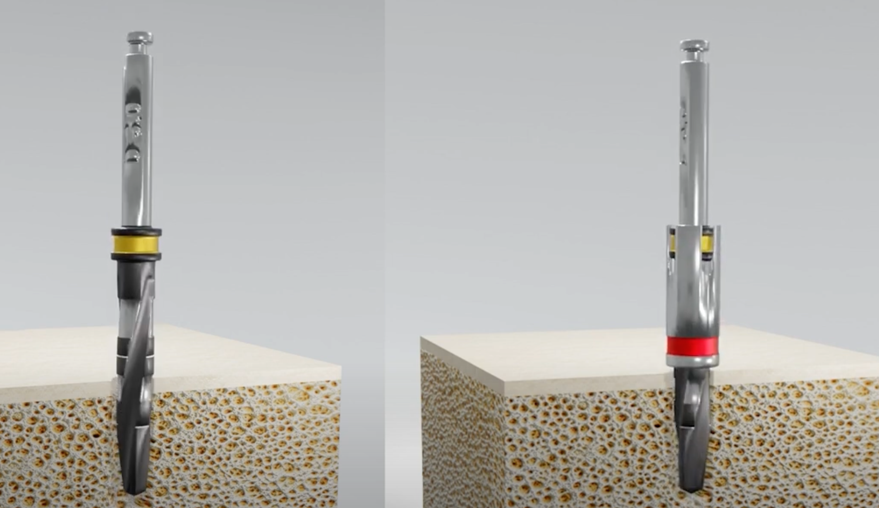 Step-by-Step: How to Place an Implant with Naxis Implant's Simplified Surgical Kit? - Blog - Naxis
